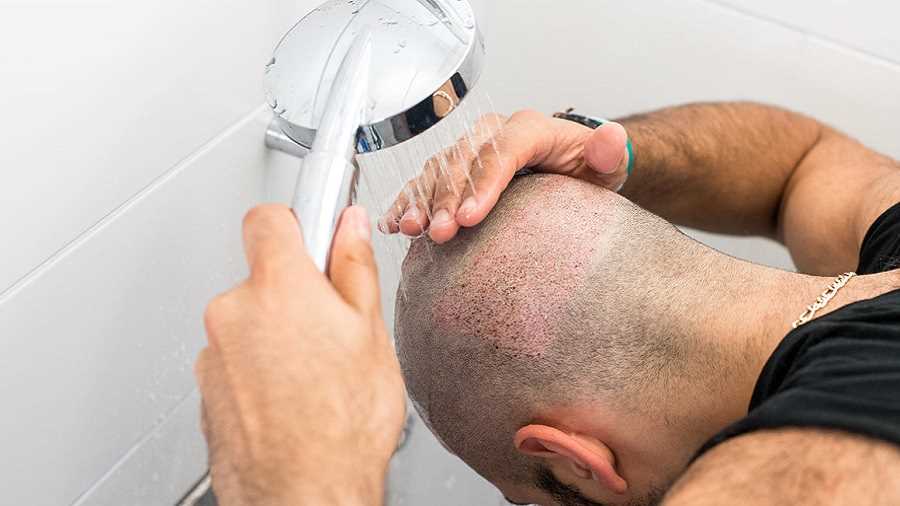 دوش گرفتن بعد کاشت مو