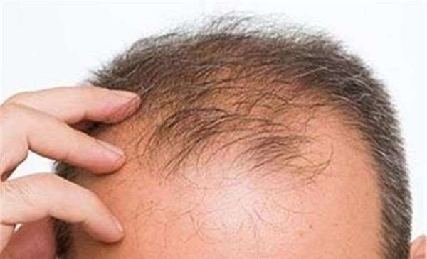 ریزش مو و عوامل موثر بر آن 
