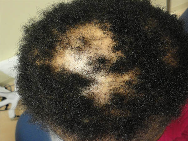 انواع ریزش مو: آلوپسی مرکزی سیکاتریک