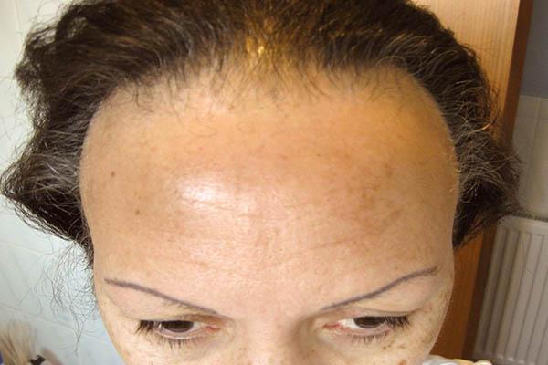 انواع ریزش مو: فیبروز آلوپسی جلوی سر