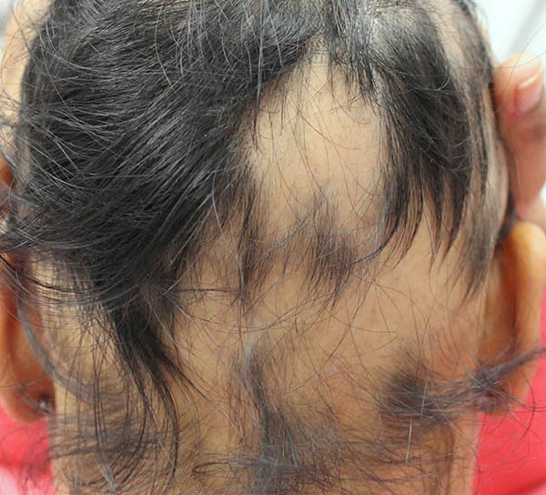 انواع ریزش مو: آناژن افلوویوم