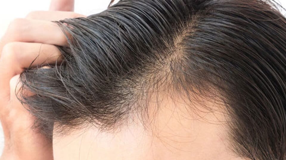 فیناستراید برای جلوگیری از ریزش مو در مردان