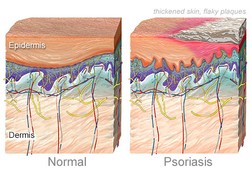 مقایسه لایه های پوستی سالم و پسوریازیس