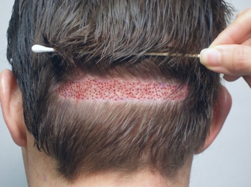 زخم های ایجاد شده از اثر کاشت مو