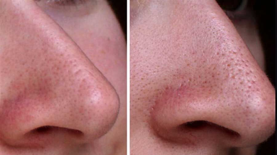 پاکسازی منافذ بینی