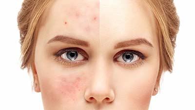 روغن سیاه دانه موثر در درمان لکه های پوستی 