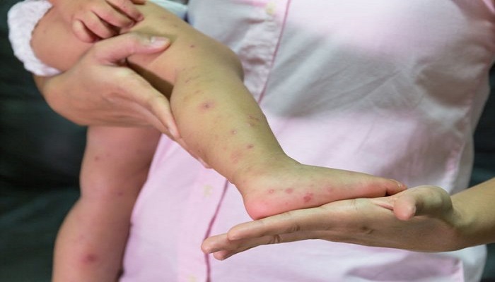 بیماری پوستی گال بر روی پا نوزادان