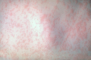 عفونت های ویروسی پوست