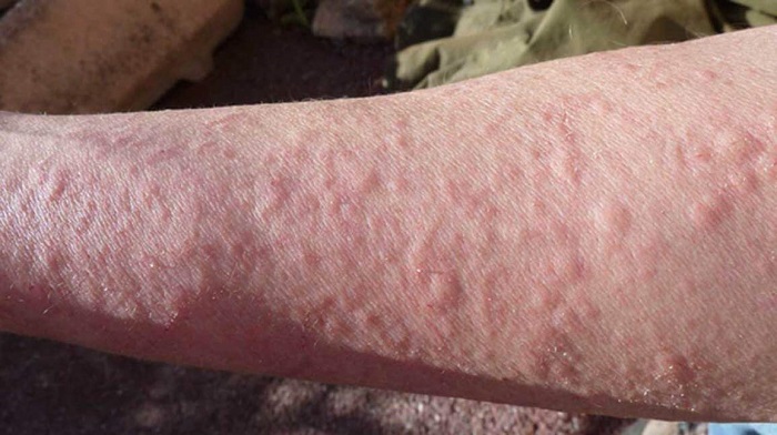 آلرژی یکی از عوامل خارش پوست