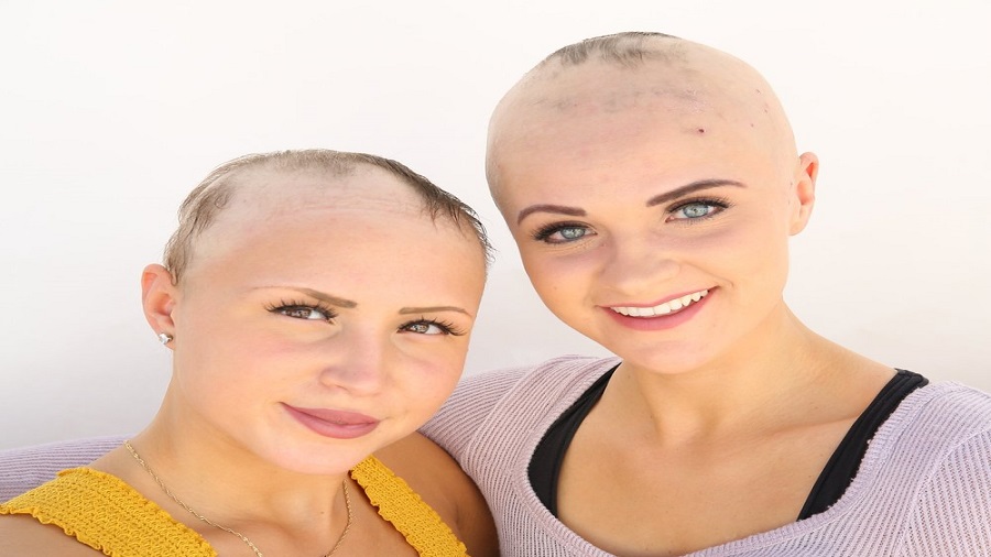 آلوپسی توتالیس