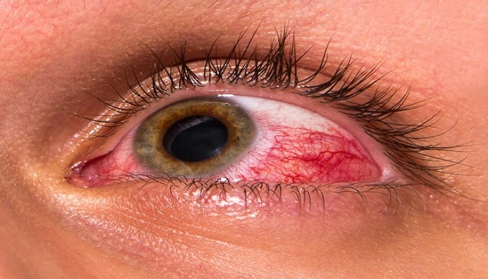 تاثیر مواد شیمیایی بر روی چشم