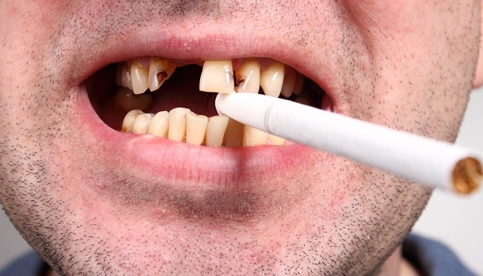 عوارض سیگار بر دهان و دندان