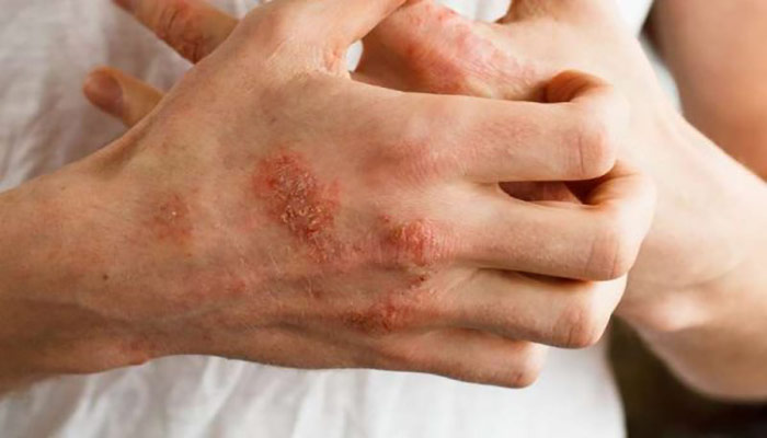 درمان عفونت های پوستی با روغن چریش