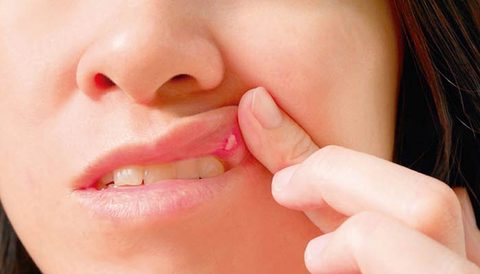 ایجاد زخم دهان از عوارض شیمی درمانی