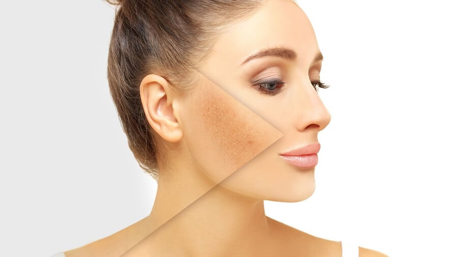 هایپرپیگمنتیشن چیست؟