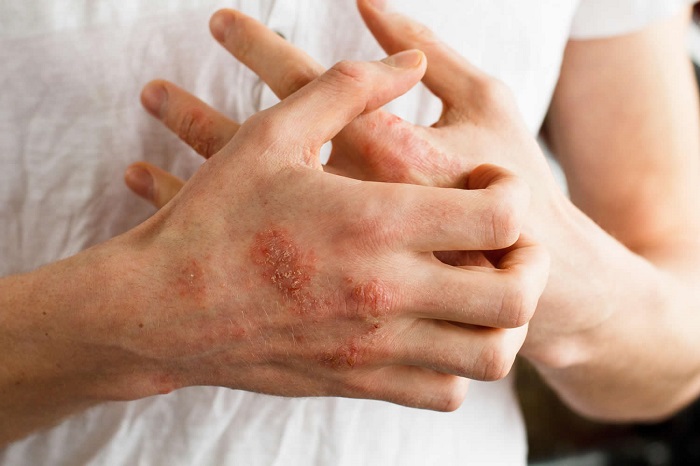 علائم آلرژی به لاتکس چیست؟