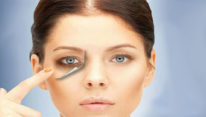 درمان حلقه های تیره زیر چشم با استفاده از کربن تراپی
