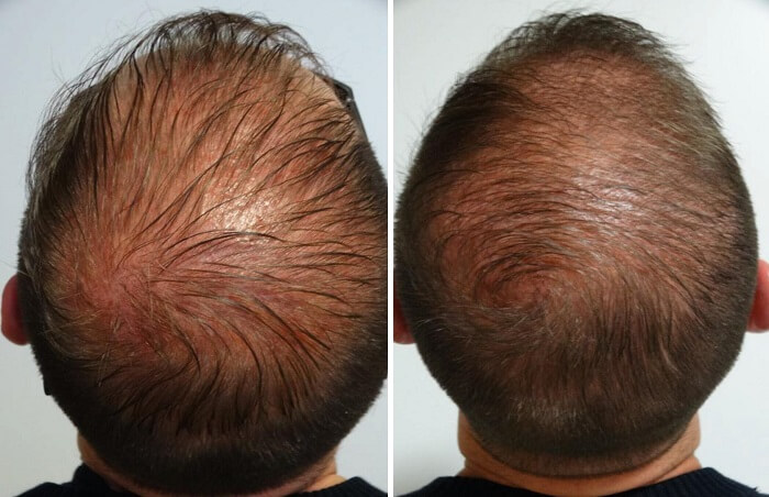 مزوتراپی مو چیست و چه کاربردی دارد؟