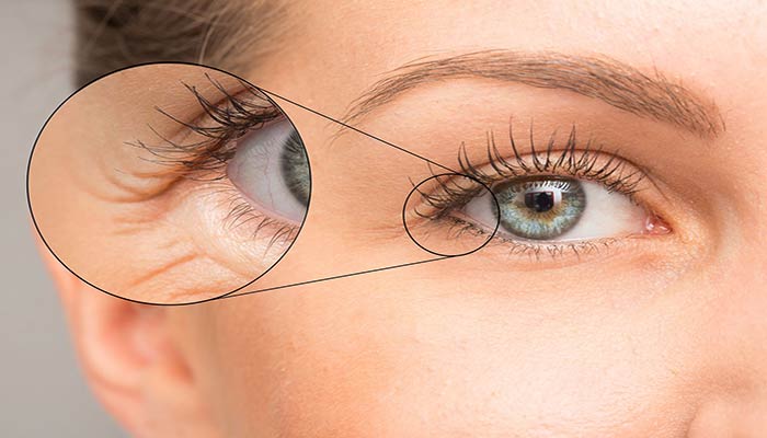کاهش خطوط ریز اطراف چشم با کرم دور چشم حاوی رتینول یا پپتیدها و اسید هیالورونیک
