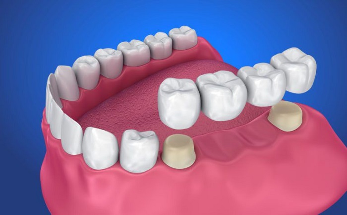 انواع مختلف پروتز دندان 