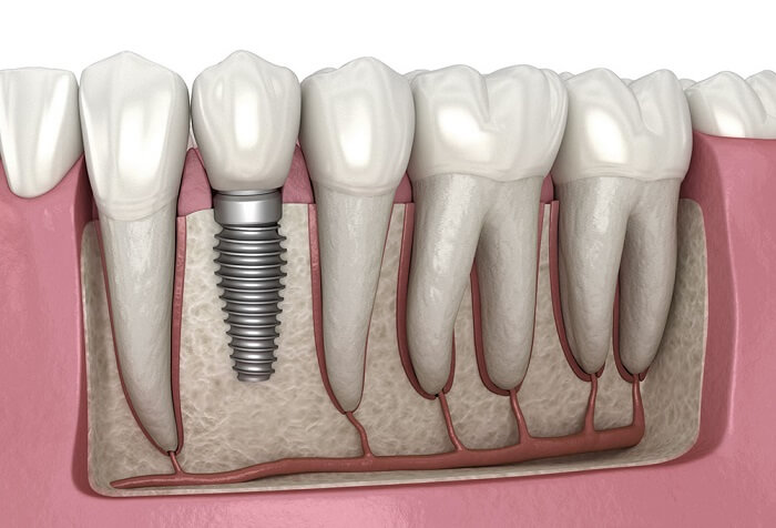 انواع پروتز دندانی؛ ایمپلنت
