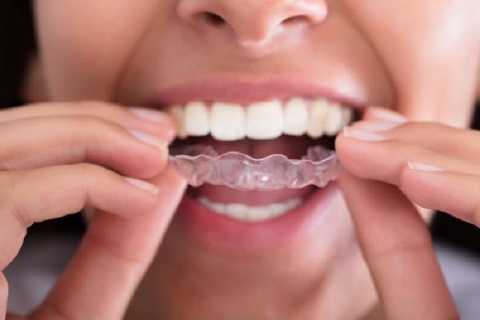 انواع پروتز دندان؛ محافظ دهان