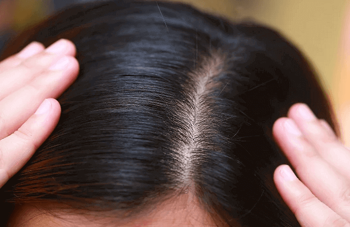 میزان تراکم مو، یکی از عوامل تشخیص نوع  مو