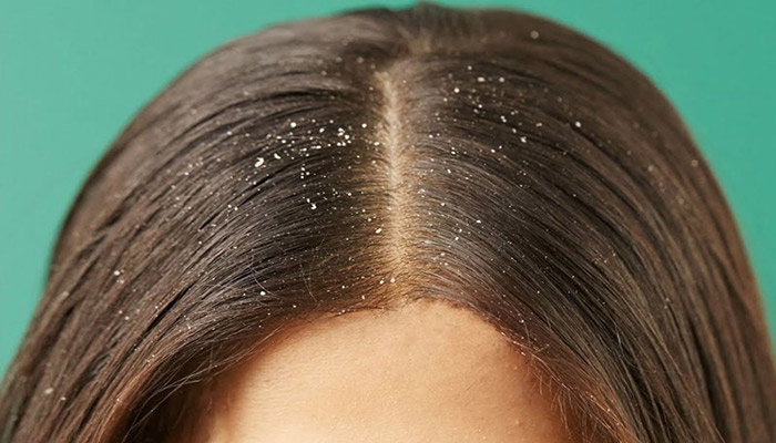 آیا شستن مو ها با جوش شیرین، برای از بین بردن شوره سر موثر است؟