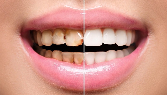 سفید کردن دندان با کامپوزیت