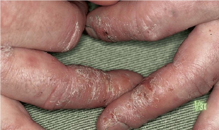 سفت شدن پوست انگشت به دلیل ایجاد درماتیک تماسی