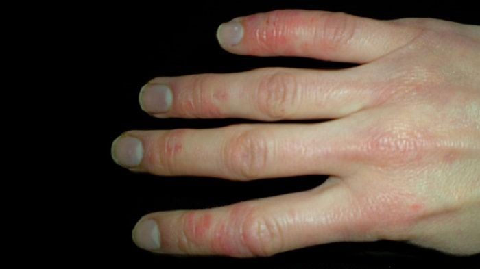 سفت شدن پوست انگشت به دلیل تاثیر بیماری اسکلرودرمی بر پوست