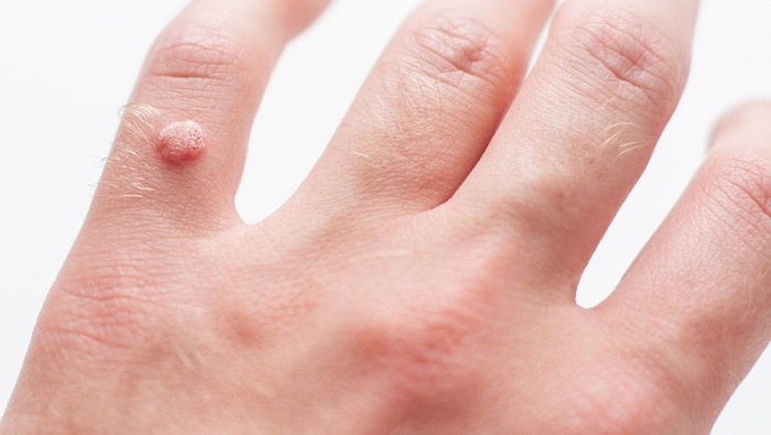 سفت شدن پوست انگشت به دلیل ایجاد زگیل