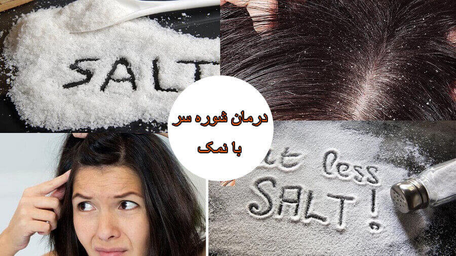 درمان شوره سر نمک