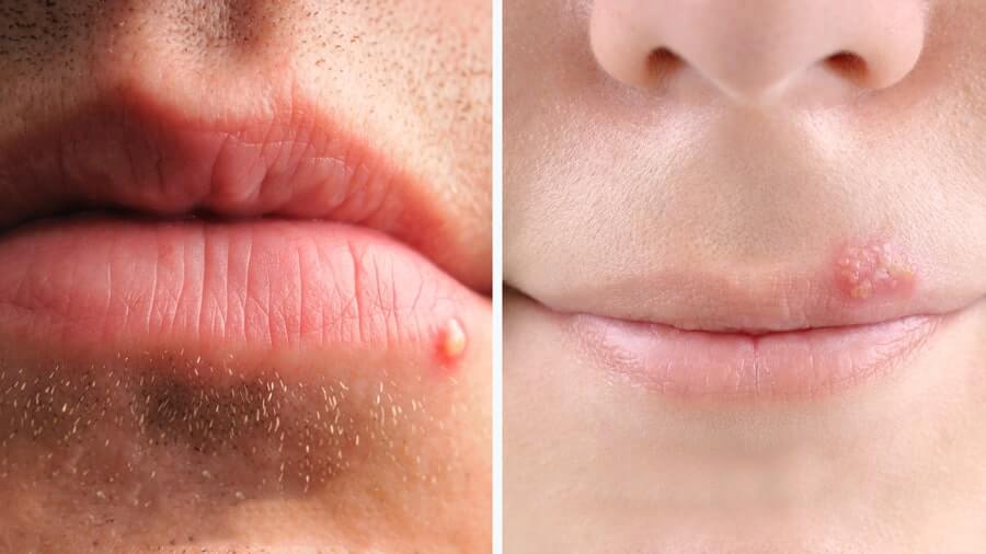تفاوت تبخال و جوش لب چیست؟ | روش تشخیص و درمان