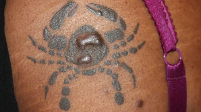 اسکار کلوئیدی یکی از عوارض تاتو