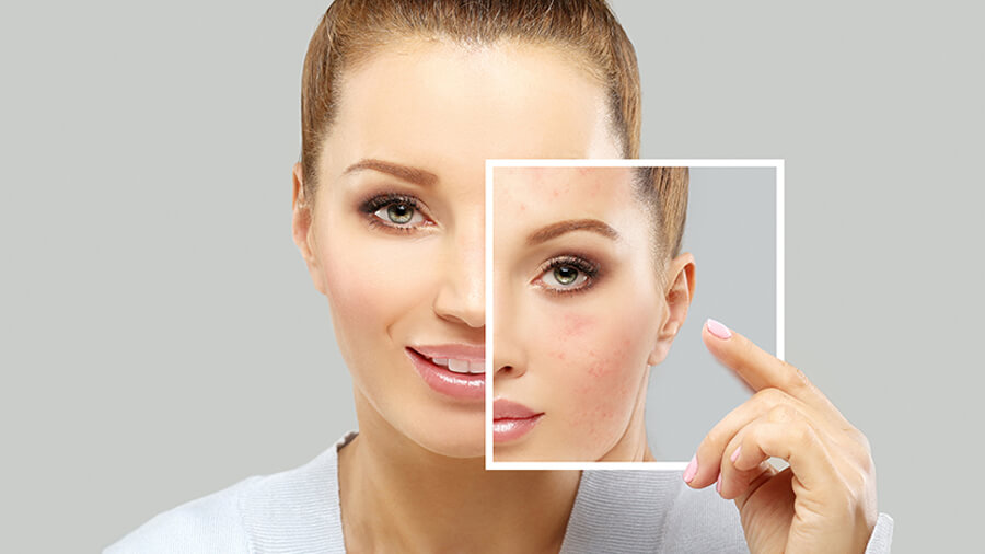 بهترین کرم ضد جوش