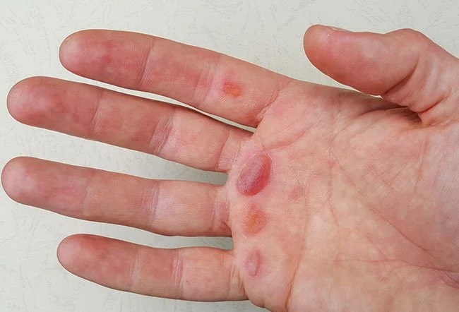 جلوگیری از تاول پوستی دست