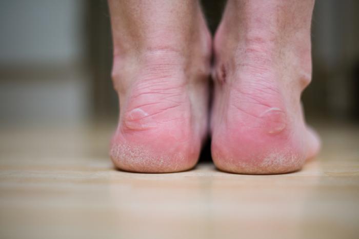 جلوگیری از تاول پوستی پا