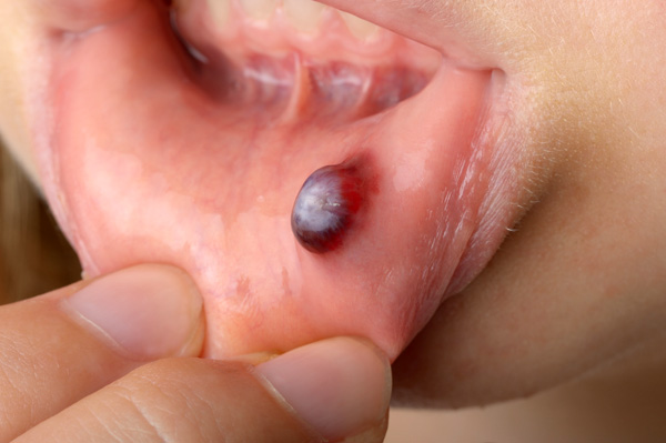 تاول خونی ایجاد شده در دهان