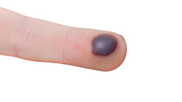 تاول خونی ایجاد شده در انگشت