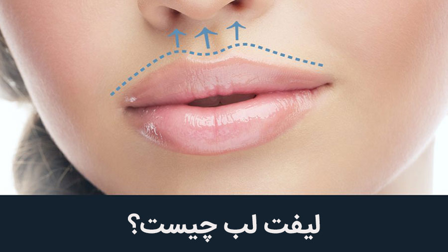 لیفت لب
